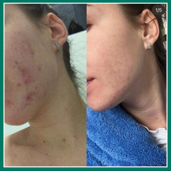 pre i posle korišćenja aktivnog kiseonika na licu