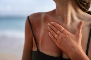 Alergija na sunce – Kako je prepoznati i zaštititi se?