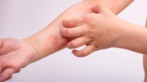Ekcem na koži ruku i lica – Kako prepoznati i tretirati simptome