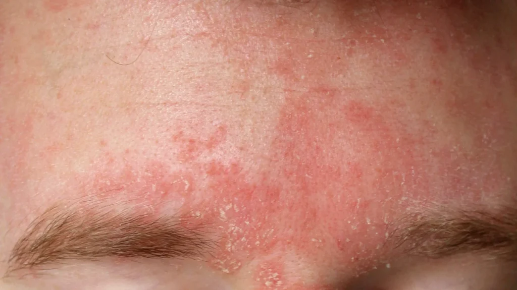 Seborejski dermatitis