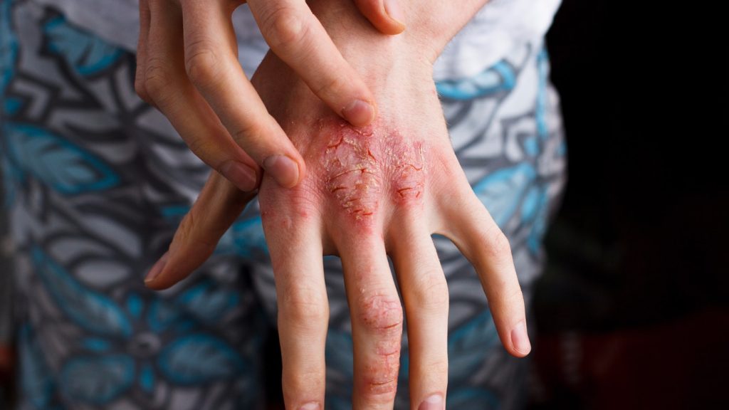 atopijski dermatitis na rukama