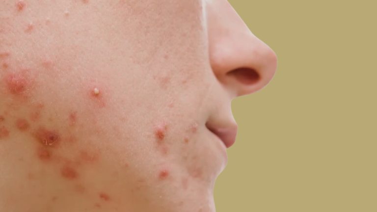 Potkožne bubuljice – Uzroci i efikasne metode lečenja