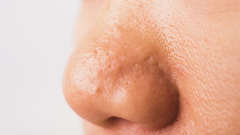 Komedoni na nosu izbliza