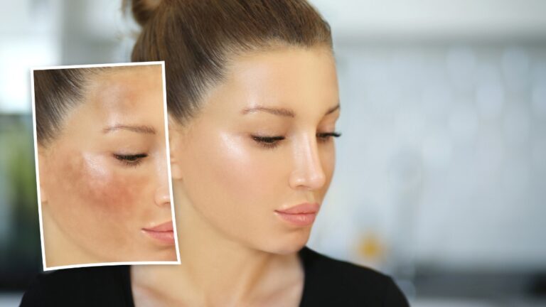 Žena sa vidljivim flekama od sunca na obrazu pre tretmana i čistom kožom nakon tretmana