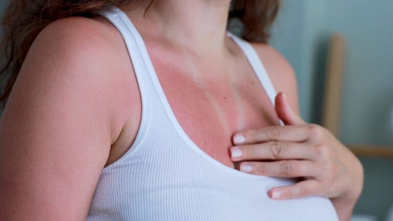 Devojka sa vidljivim opekotinama od sunca na dekolteu