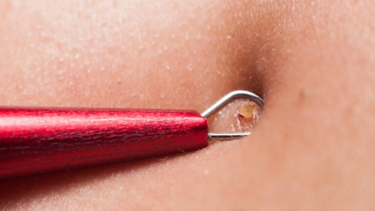 Crveni metalni alat za uklanjanje mitisera pritisnut uz kožu, iz pore izlazi sadržaj u obliku čepa