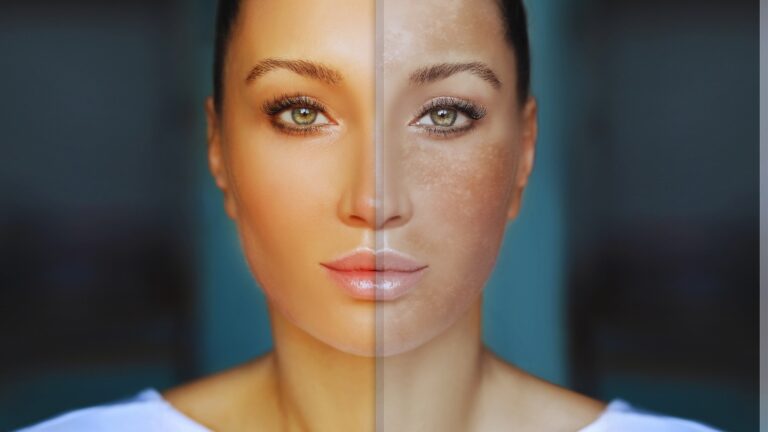 Lice žene podeljeno na dva dela – levo prikazuje ujednačen, zdrav ten, dok desno otkriva tamne fleke i promene tipične za hiperpigmentaciju