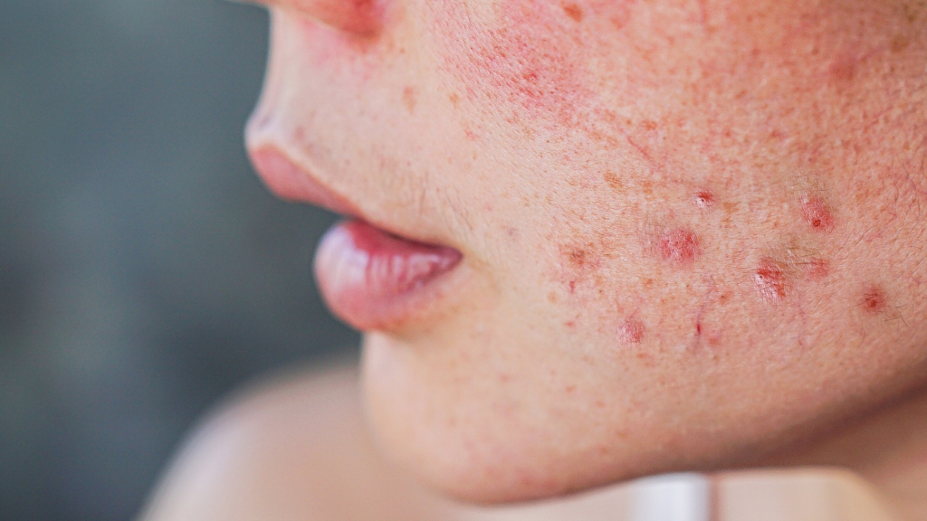 Žena sa aknama i crvenilom na obrazima