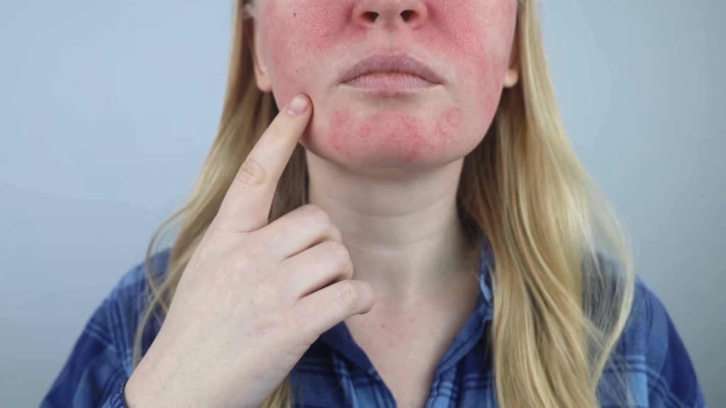 Žena sa rozaceom na licu