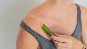 Za šta je dobra aloe vera – kako deluje na kožu, opekotine i iritacije